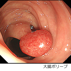 大腸ポリープ