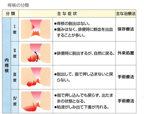 痔核の分類