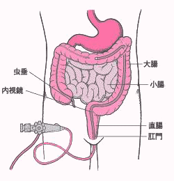 内視鏡検査図