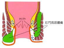 肛門周囲膿瘍