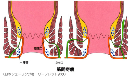 筋間痔瘻