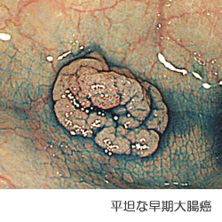 平坦な早期大腸癌