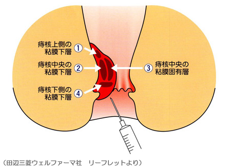 注射 後遺症 ジオン