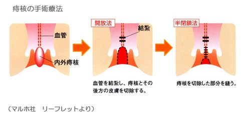 痔核の手術療法